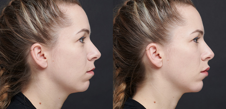 Before After Art Filler Injection