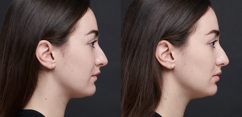 Before After Lip Correction