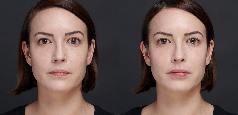 Before After Lips Injection (Artfiller)